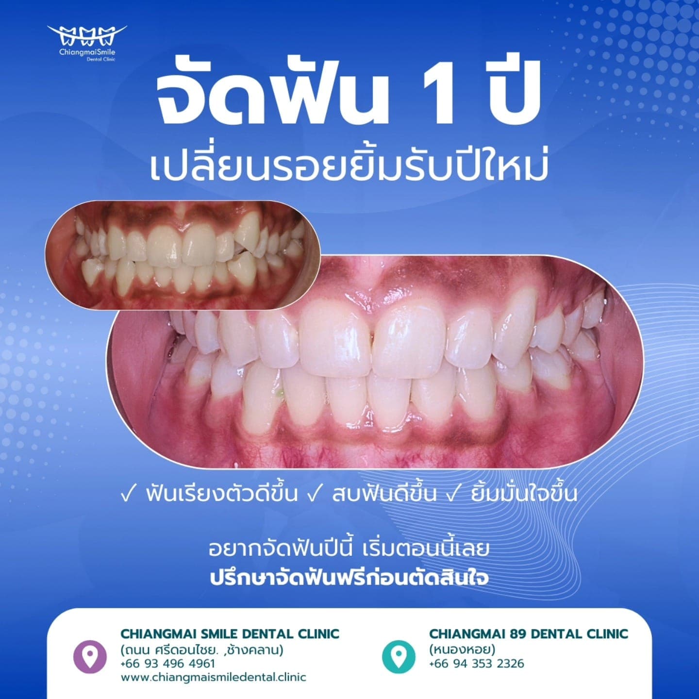 จัดฟัน 1 ปี เปลี่ยนรอยยิ้มรับปีใหม่ ฟันเรียงสวย สบฟันดี ยิ้มมั่นใจขึ้น
