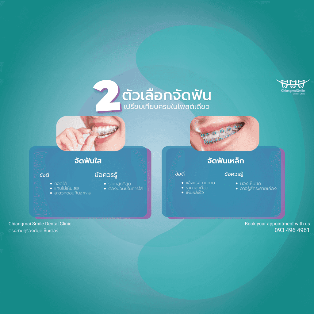 ตัวเลือกในการจัดฟัน จัดฟันเหล็ก vs จัดฟันใส