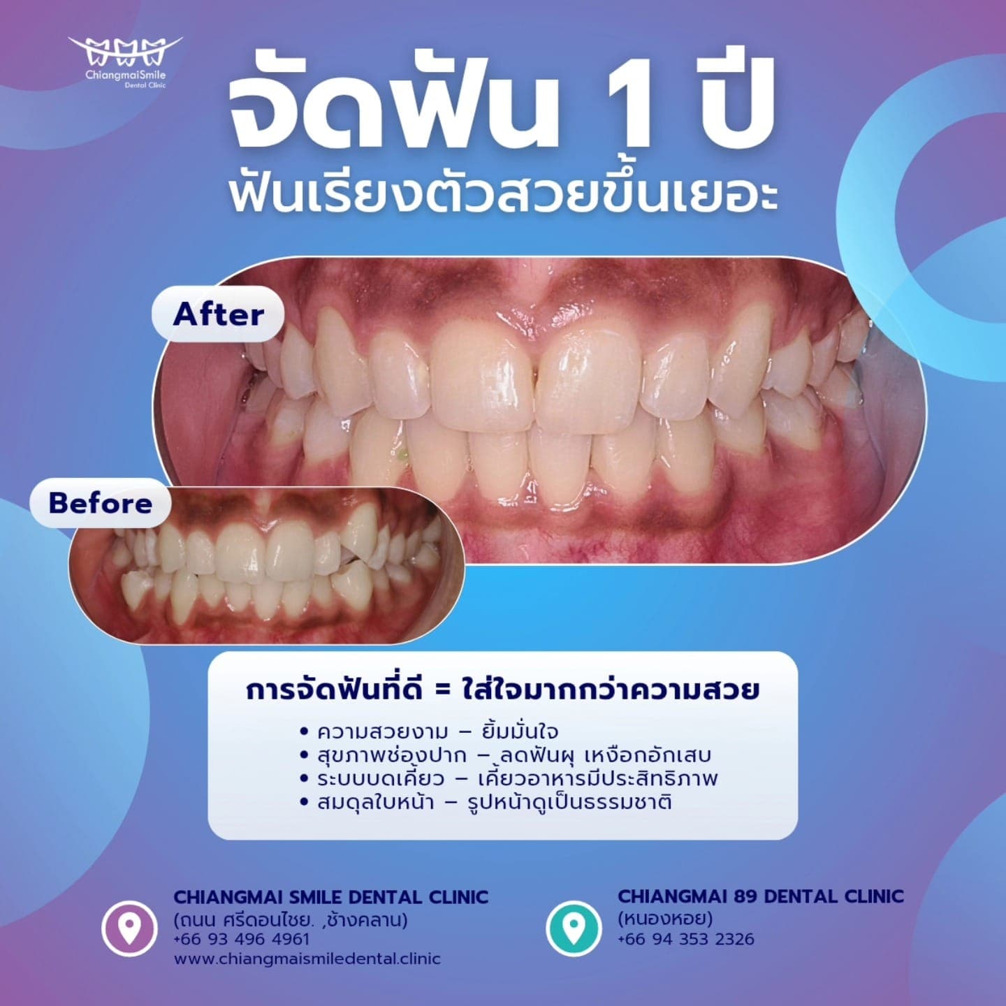 ฟันเรียงสวย สมดุลโครงหน้า ดูแลสุขภาพระยะยาว