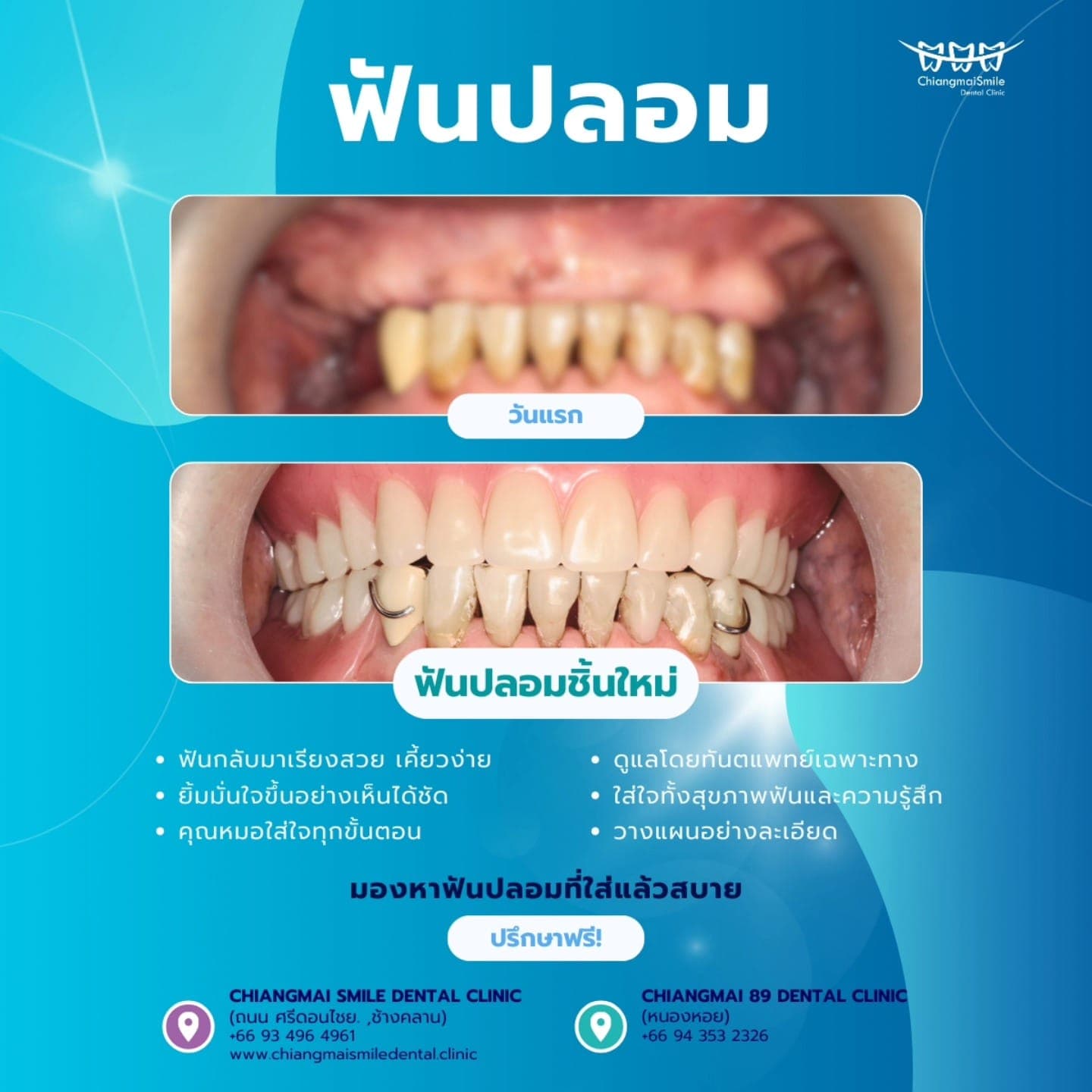 ฟันปลอมที่ใส่แล้วสบาย… คืนพลังการเคี้ยว พร้อมรอยยิ้มที่เป็นคุณที่สุด