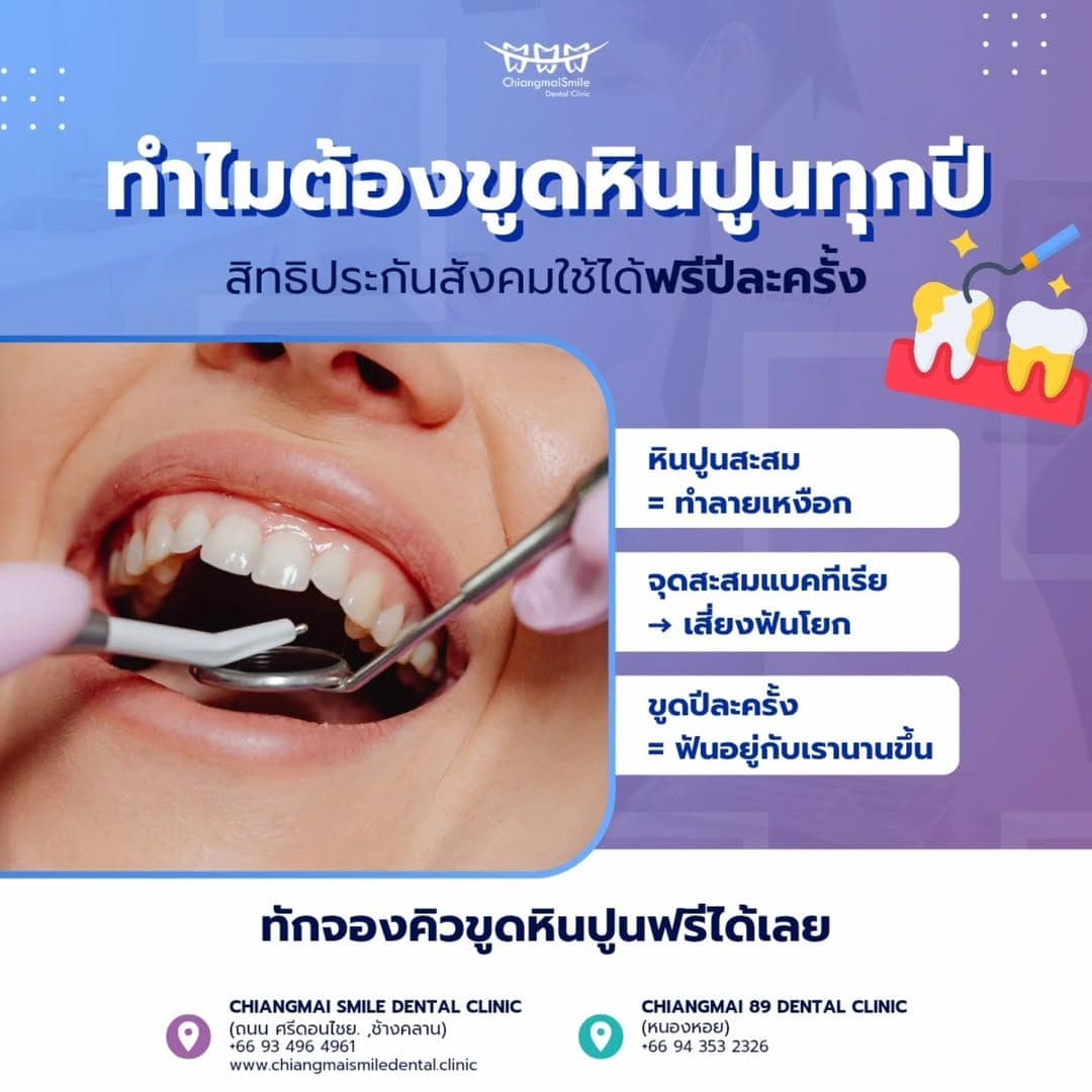 ทำไมต้องขูดหินปูนทุกปี? ใช้ "สิทธิ์ประกันสังคมทำฟันฟรี" ไม่ต้องสำรองจ่าย!
