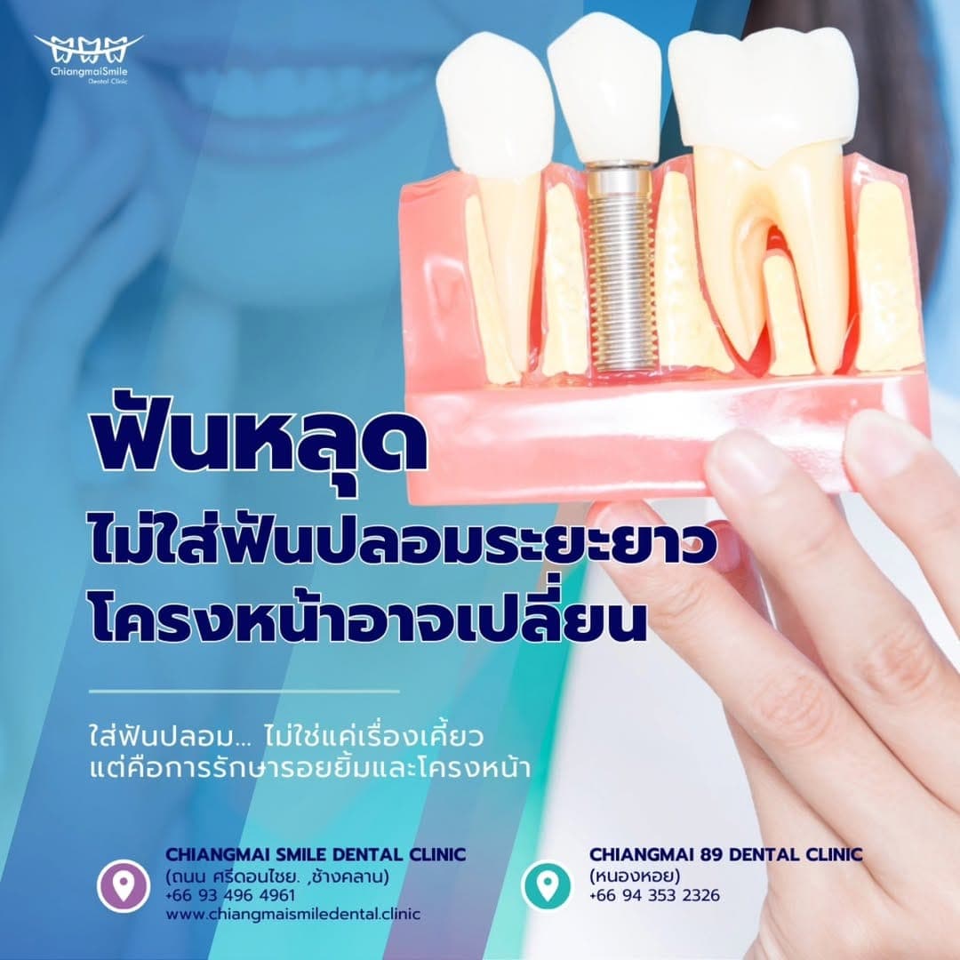 5 สัญญาณที่บอกว่าคุณอาจต้องใส่ฟันปลอม
